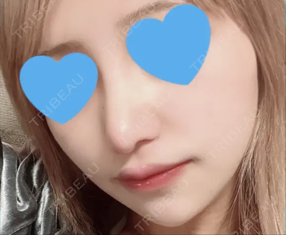 隆鼻術 / 鼻尖形成（切開） / 鼻中隔延長（切開） / 小鼻縮小（切開） / 軟骨移植 / 鼻尖縮小 R Beauty CLINIC 銀座院 DAY 16 メイン用