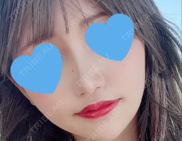 隆鼻術 / 鼻尖形成（切開） / 鼻中隔延長（切開） / 小鼻縮小（切開） / 軟骨移植 / 鼻尖縮小 R Beauty CLINIC 銀座院 DAY 65 メイン用