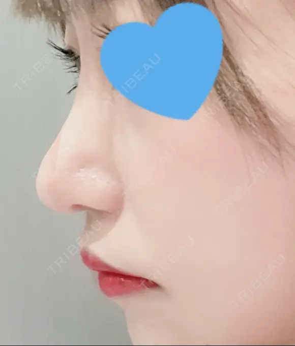 隆鼻術 / 鼻尖形成（切開） / 鼻中隔延長（切開） / 小鼻縮小（切開） / 軟骨移植 / 鼻尖縮小 R Beauty CLINIC 銀座院 AFTER メイン用