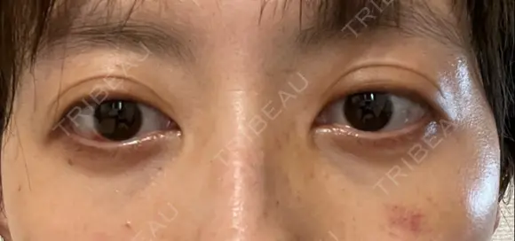 下まぶたの脂肪取り APOLLO BEAUTY CLINIC AFTER メイン用