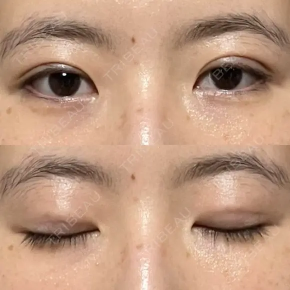 二重埋没 / その他（目元） 湘南美容クリニック 藤沢院 DAY 6 メイン用