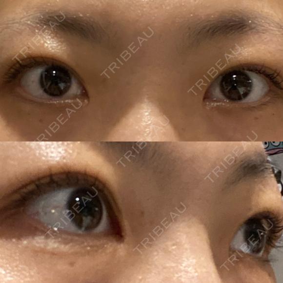 目頭切開 LUHO（ルホ）美容外科 DAY 94 メイン用