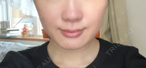 ボトックス（エラ・小顔） ルラ美容クリニック 札幌本院 DAY 7 メイン用