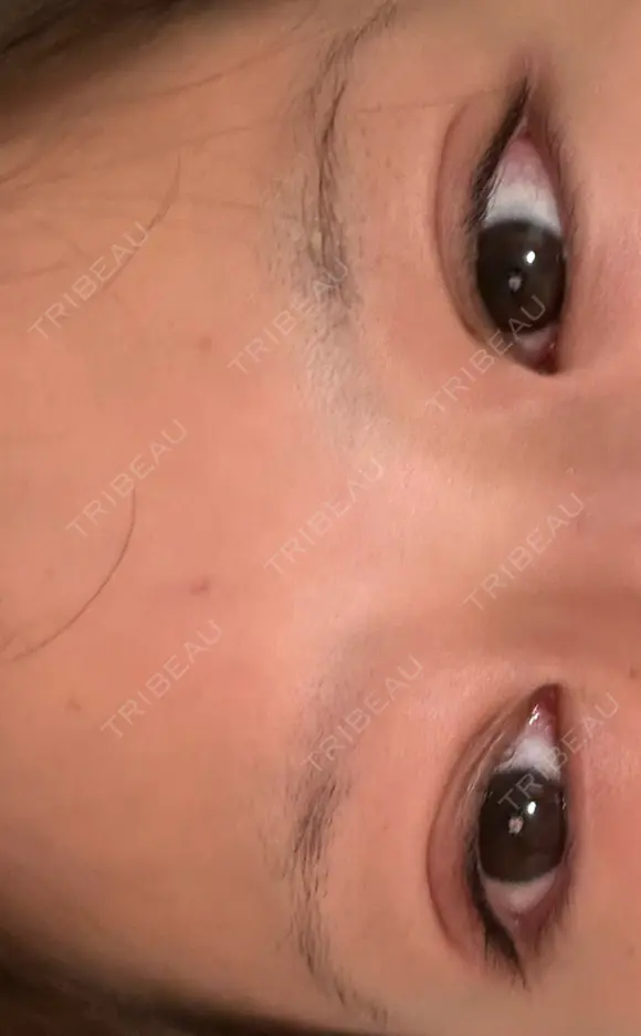 下まぶたの脂肪取り APOLLO BEAUTY CLINIC DAY 9 メイン用