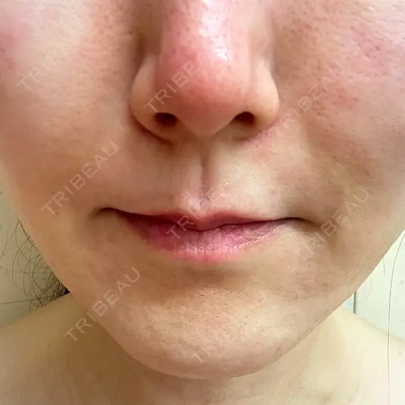 ボトックス（あご） / ヒアルロン酸注入（鼻翼基部） / その他（口元） ルラ美容クリニック 東京駅前院 DAY 13 メイン用