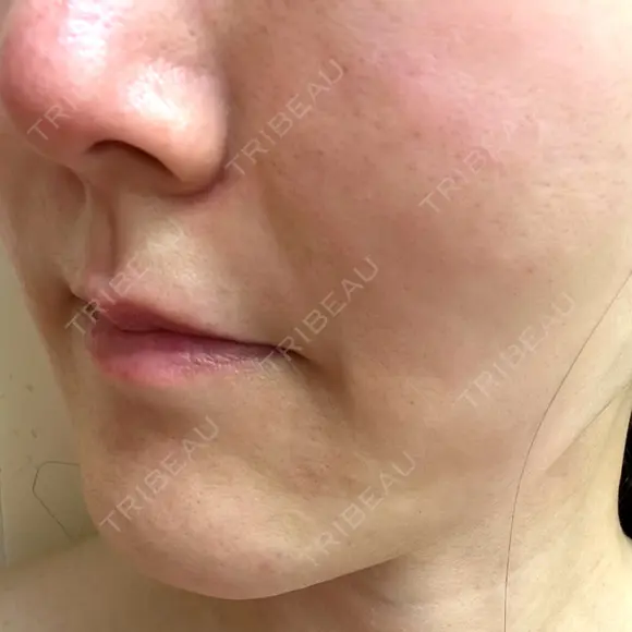 ボトックス（あご） / ヒアルロン酸注入（鼻翼基部） / その他（口元） ルラ美容クリニック 東京駅前院 DAY 13 メイン用