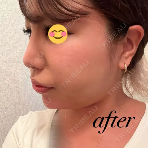 ヒアルロン酸注入（鼻） / ヒアルロン酸注入（あご） / 美容点滴・美容注射（疲労回復） HAAB×DREAM BEAUTY CLINIC 大阪梅田院 DAY 0 メイン用