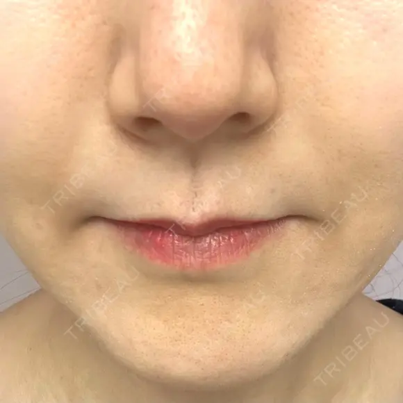 ボトックス（あご） / ヒアルロン酸注入（鼻翼基部） / その他（口元） ルラ美容クリニック 東京駅前院 AFTER メイン用