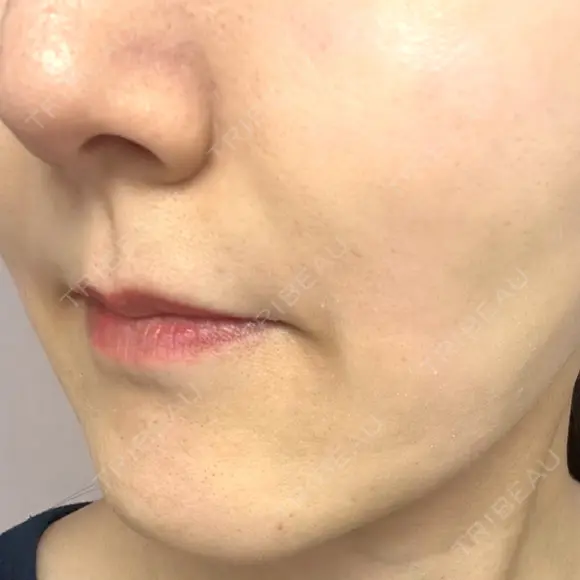 ボトックス（あご） / ヒアルロン酸注入（鼻翼基部） / その他（口元） ルラ美容クリニック 東京駅前院 DAY 14 メイン用