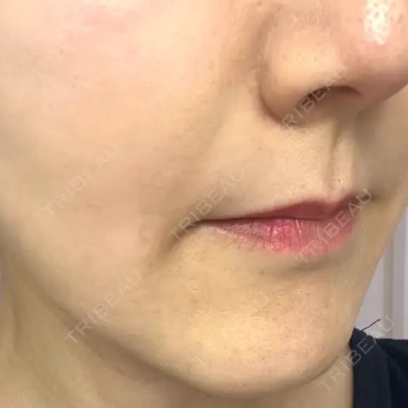 ボトックス（あご） / ヒアルロン酸注入（鼻翼基部） / その他（口元） ルラ美容クリニック 東京駅前院 DAY 14 メイン用