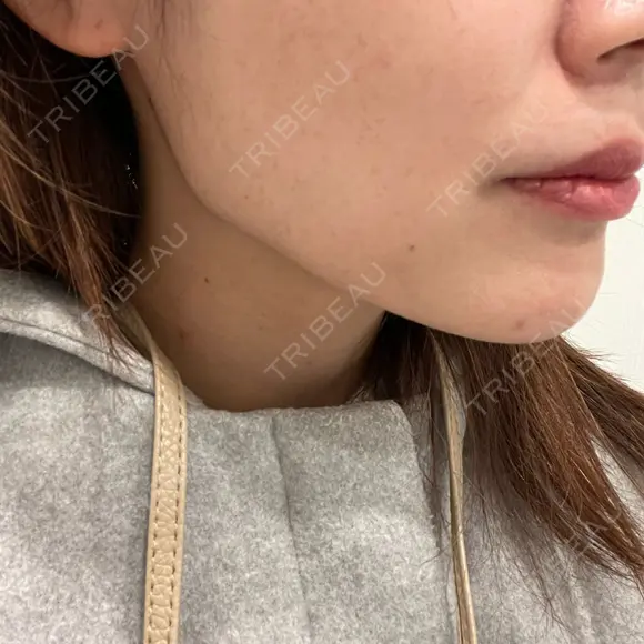 ボトックス（エラ・小顔） / ボトックス（眉間） / ボトックス（額） / その他（鼻） TCB東京中央美容外科 梅田茶屋町院 DAY 0 メイン用