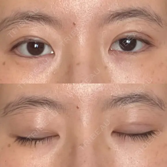 二重埋没 / その他（目元） 湘南美容クリニック 藤沢院 DAY 7 メイン用