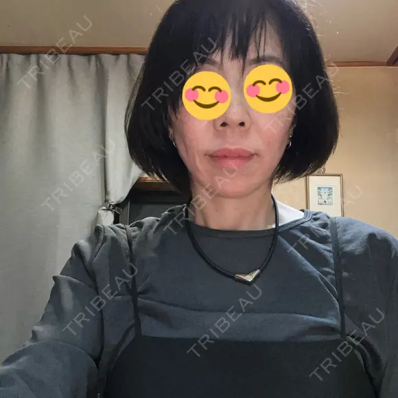 ボトックス（あご） / ボトックス（口角） / ボトックス（眉間） / ボトックス（目尻） / ボトックス（額） / ボトックス（人中） DMTC美容皮膚科 大宮院 AFTER メイン用