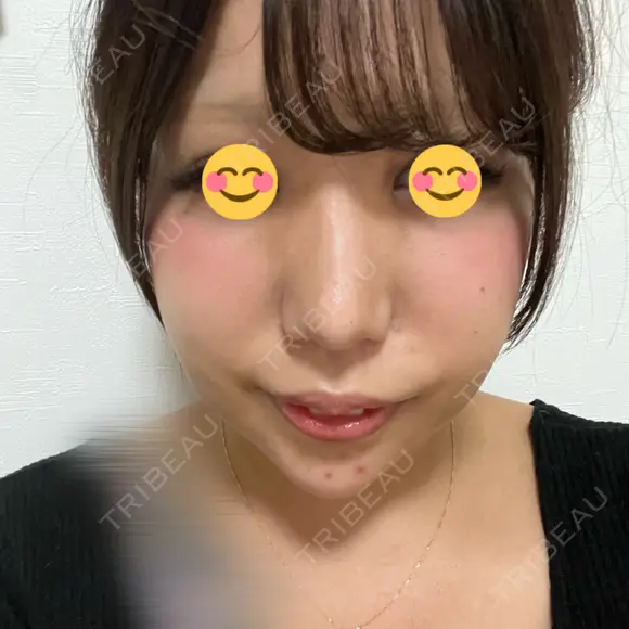 ヒアルロン酸注入（鼻） / ヒアルロン酸注入（あご） / 美容点滴・美容注射（疲労回復） HAAB×DREAM BEAUTY CLINIC 大阪梅田院 DAY 1 メイン用