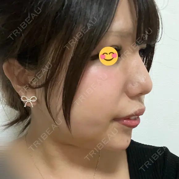 ヒアルロン酸注入（鼻） / ヒアルロン酸注入（あご） / 美容点滴・美容注射（疲労回復） HAAB×DREAM BEAUTY CLINIC 大阪梅田院 DAY 1 メイン用