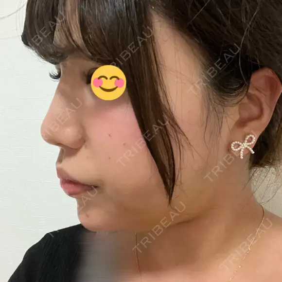 ヒアルロン酸注入（鼻） / ヒアルロン酸注入（あご） / 美容点滴・美容注射（疲労回復） HAAB×DREAM BEAUTY CLINIC 大阪梅田院 DAY 1 メイン用