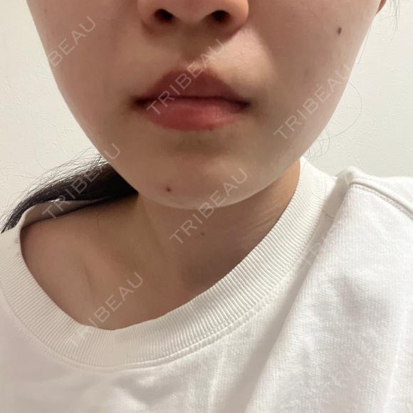 ボトックス（エラ・小顔） Original Beauty Clinic GINZA AFTER メイン用