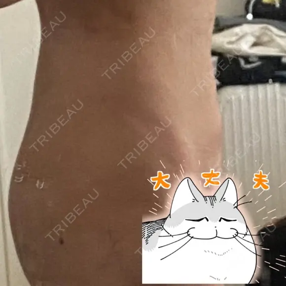 脂肪吸引（脚） / 脂肪吸引（お腹） / 脂肪吸引（お尻） / 豊胸（脂肪注入） S.T styleクリニック DAY 3 メイン用