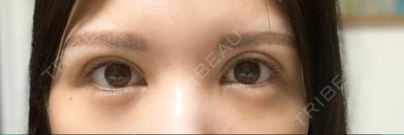 二重切開 / 目頭切開 / 眼瞼下垂（切開） / 上まぶたの脂肪取り エターナル美容クリニック DAY 170 メイン用