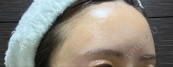 脂肪注入（額） / ボトックス（眉間） / ボトックス（額） GRACIA clinic 【グラシアクリニック】 DAY 26 メイン用