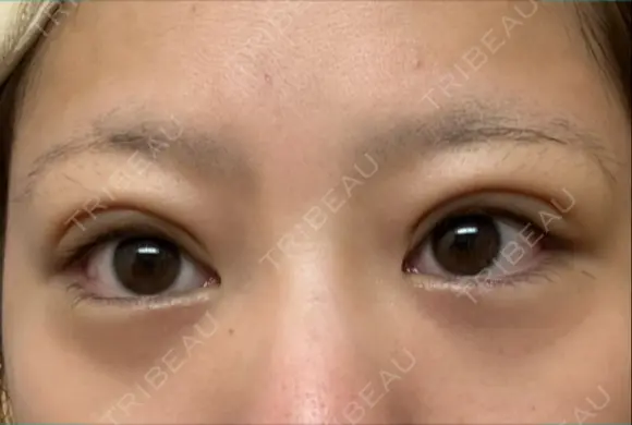 下まぶたの脂肪取り APOLLO BEAUTY CLINIC DAY 12 メイン用
