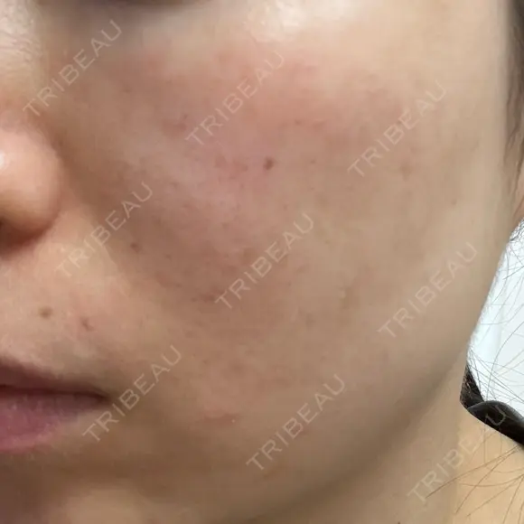 エレクトロポレーション / フォトシルクプラス もとび美容外科クリニック 新宿院 DAY 0 メイン用