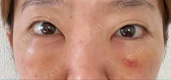 クマ治療 / 下まぶたたるみ取り / 下まぶたの脂肪取り / 脂肪注入（目の下） 湘南美容クリニック 千葉センシティ院 DAY 3 メイン用