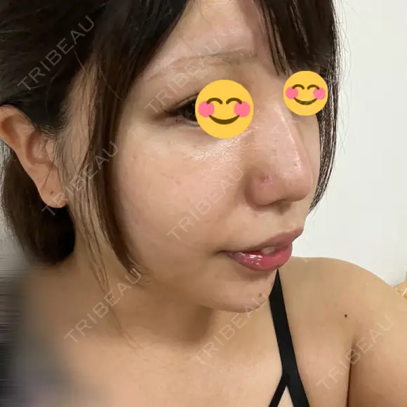 ヒアルロン酸注入（鼻） / ヒアルロン酸注入（あご） / 美容点滴・美容注射（疲労回復） HAAB×DREAM BEAUTY CLINIC 大阪梅田院 DAY 3 メイン用