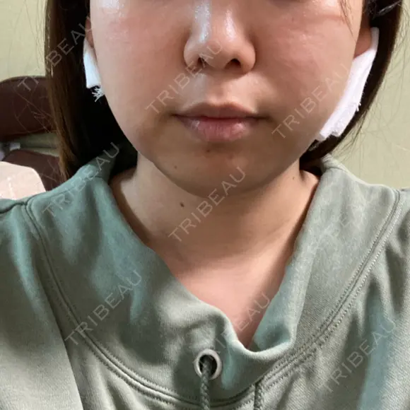 脂肪吸引（顔） R Beauty CLINIC 名古屋院 DAY 1 メイン用