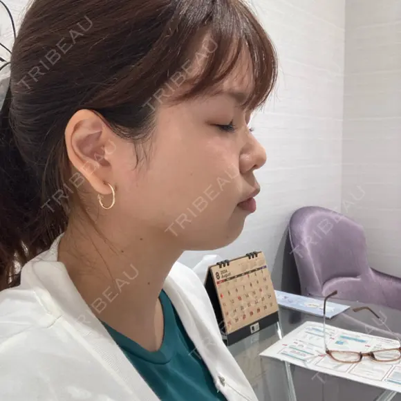 脂肪吸引（顔） R Beauty CLINIC 名古屋院 DAY 35 メイン用