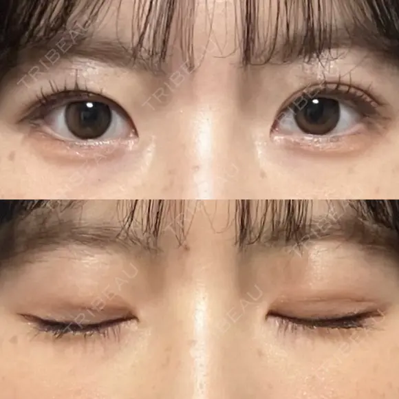 二重埋没 / その他（目元） 湘南美容クリニック 藤沢院 DAY 10 メイン用