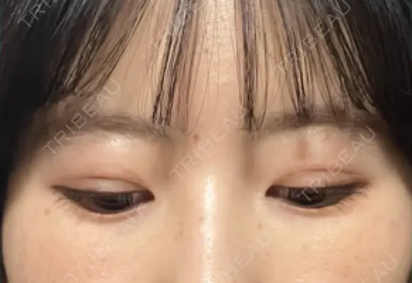 二重埋没 / その他（目元） 湘南美容クリニック 藤沢院 DAY 10 メイン用