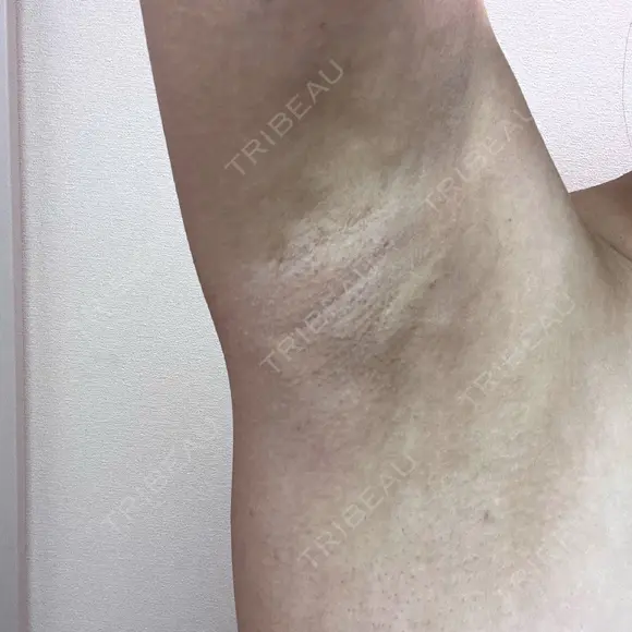 ワキ汗治療（レーザー） Fellez Clinic【フェルズクリニック】 DAY 22 メイン用