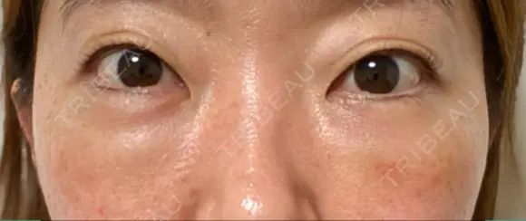 クマ治療 / 下まぶたたるみ取り / 下まぶたの脂肪取り / 脂肪注入（目の下） 湘南美容クリニック 千葉センシティ院 DAY 6 メイン用