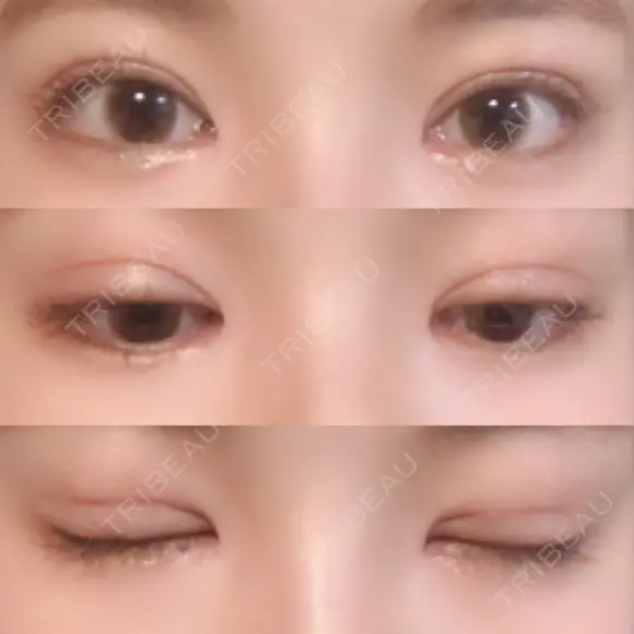 二重切開 / 目頭切開 / 眼瞼下垂（切開） / その他（目元） / 上まぶたの脂肪取り レアート整形外科 DAY 28 メイン用