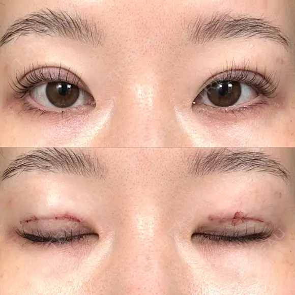 二重埋没 / ボトックス（エラ・小顔） / ボトックス（肩） THE FIRST CLINIC 多摩センター院 DAY 0 メイン用