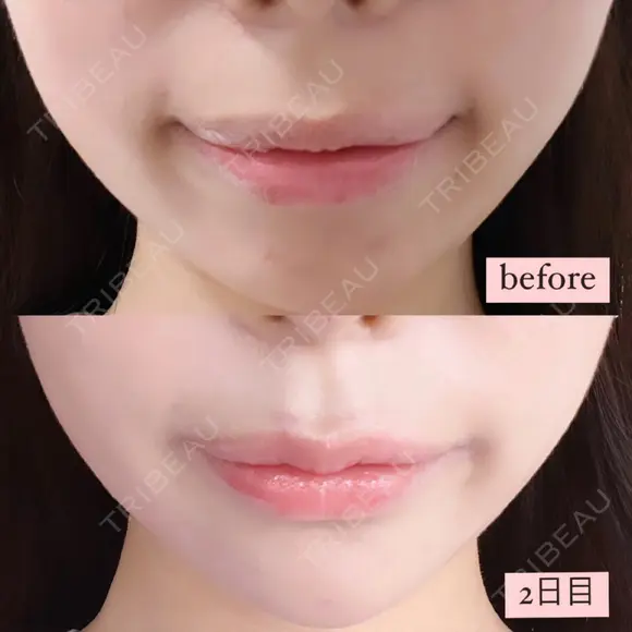 ヒアルロン酸注入（鼻） / ヒアルロン酸注入（あご） / ヒアルロン酸注入（唇） ヴェリテクリニック 大阪院 AFTER メイン用