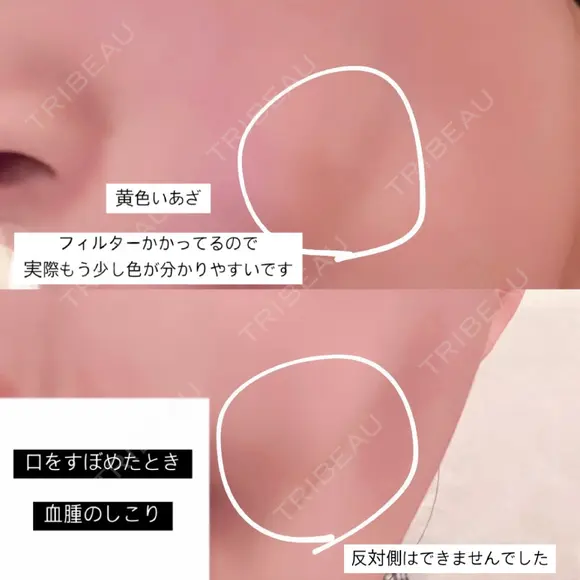 ヒアルロン酸注入（鼻） / ヒアルロン酸注入（あご） / ヒアルロン酸注入（唇） ヴェリテクリニック 大阪院 DAY 3 メイン用