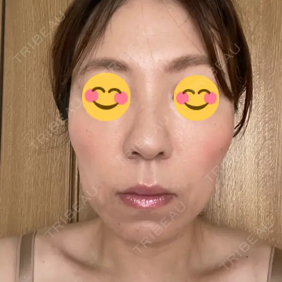 脂肪吸引（顔） / 脂肪吸引（お腹） / 豊胸（脂肪注入） / 脂肪注入（肌） / 乳頭縮小 / 脂肪吸引（腰） / ボトックス（エラ・小顔） Mods Clinic（モッズクリニック） 大阪院 AFTER メイン用