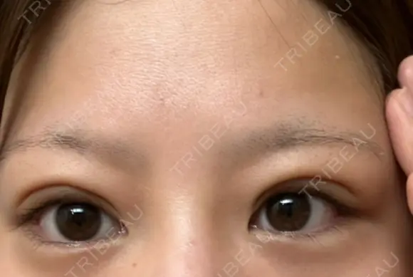 下まぶたの脂肪取り APOLLO BEAUTY CLINIC DAY 15 メイン用