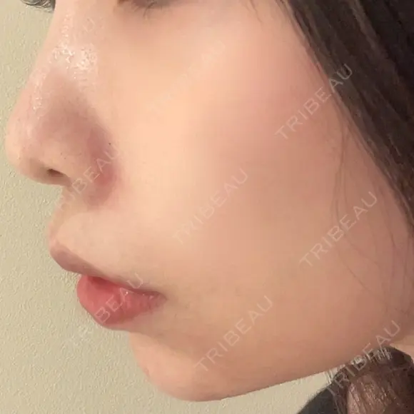 ヒアルロン酸注入（あご） / ヒアルロン酸注入（鼻翼基部） KAGA CLINIC DAY 0 メイン用