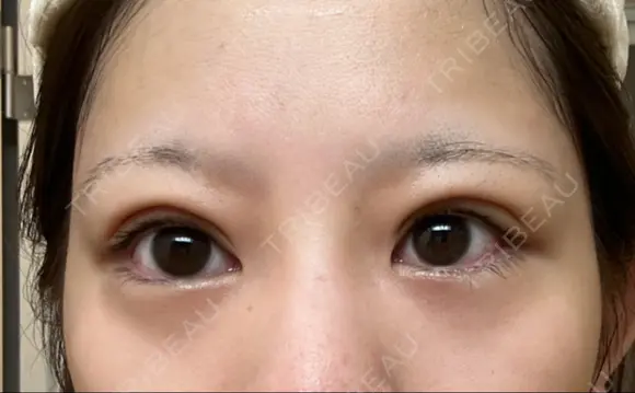 下まぶたの脂肪取り APOLLO BEAUTY CLINIC DAY 16 メイン用