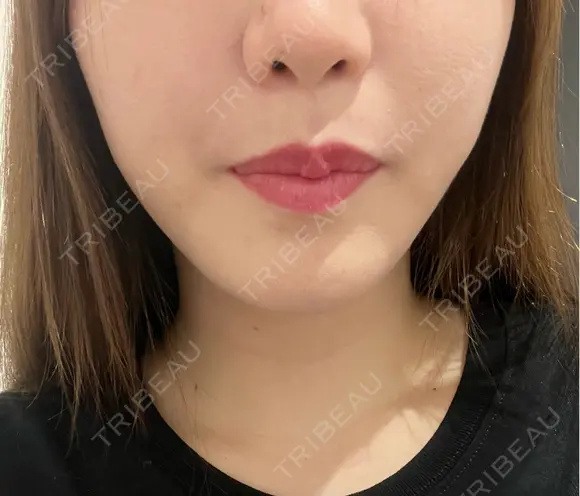 二重埋没 / 目頭切開 / 糸リフト / 脂肪吸引（顔） / ヒアルロン酸注入（涙袋） R Beauty CLINIC 名古屋院 AFTER メイン用
