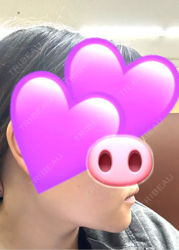 ボトックス（エラ・小顔） / ボトックス（口角） ビューティースキンクリニック 池袋院 DAY 8 メイン用