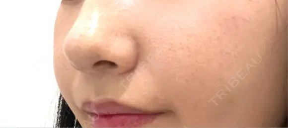 脂肪溶解注射（顔） アリエル美容クリニック 郡山院 AFTER メイン用