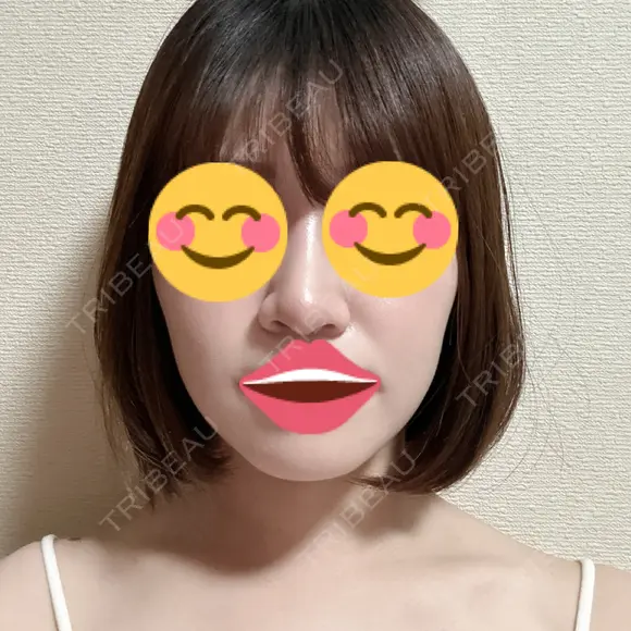 ボトックス（あご） / ボトックス（エラ・小顔） / ボトックス（肩） / ハイフ（顔） TCB東京中央美容外科 船橋院 AFTER メイン用