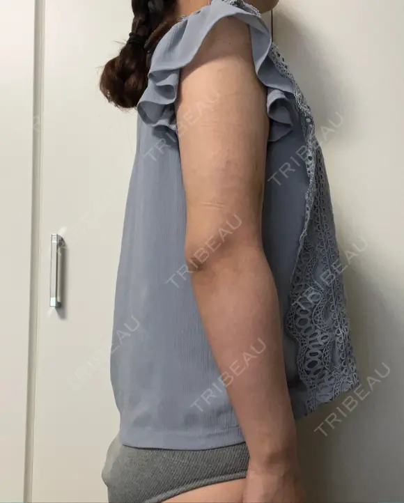 脂肪吸引（二の腕） / 脂肪吸引（背中） / 脂肪吸引（肩） 湘南美容クリニック 京都院 DAY 13 メイン用