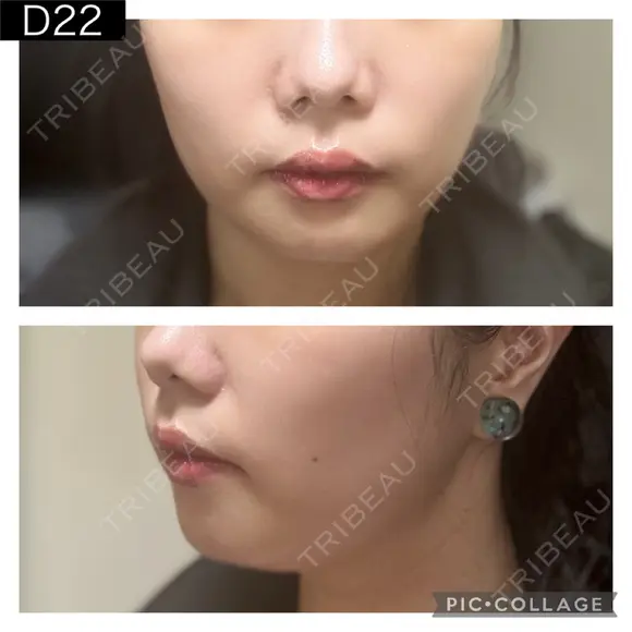 糸リフト PRISM Beauty Clinic 町田院 DAY 22 メイン用