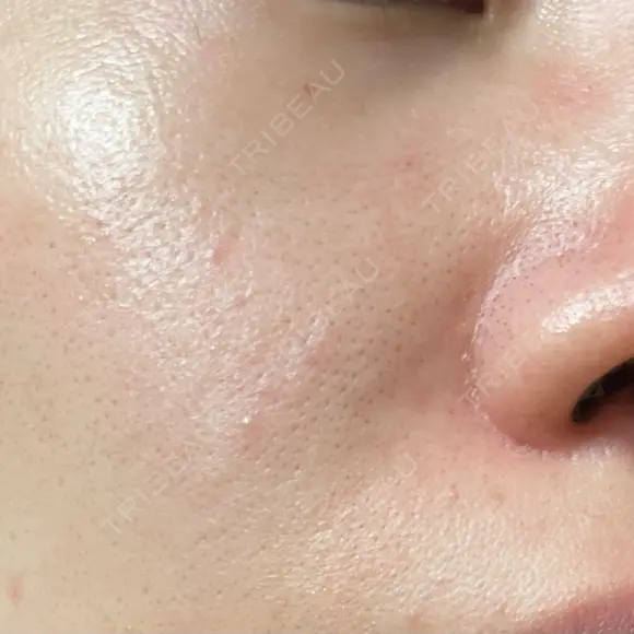 医療脱毛（顔） エスクリニック 恵比寿 DAY 1 メイン用