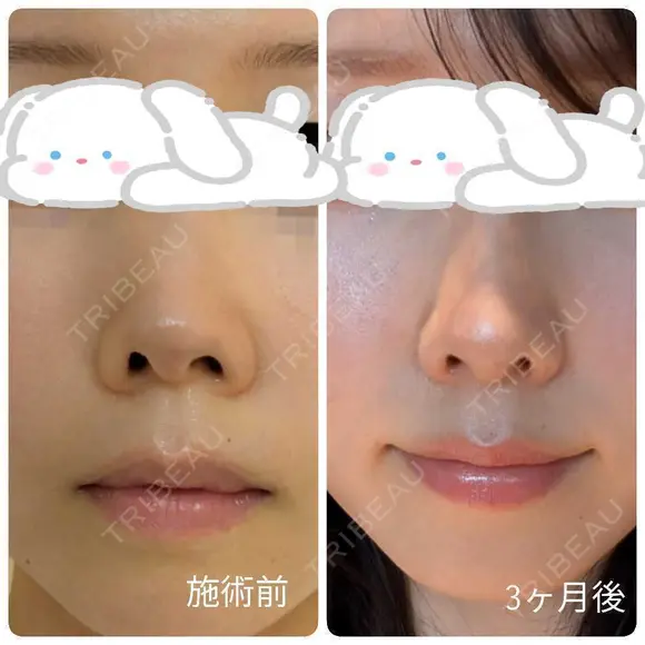 隆鼻術 / 鼻尖形成（切開） / 小鼻縮小（切開） / 軟骨移植 / 鼻柱下降・鼻唇角形成（猫手術） / ボトックス（エラ・小顔） / 毛穴洗浄（ハイドラフェイシャルなど） グローバルビューティークリニック 大阪院 DAY 90 メイン用